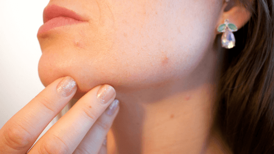 el colageno reduce el acne