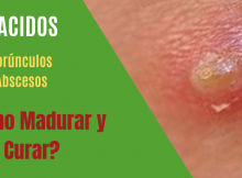 Como madurar y curar un forunculo
