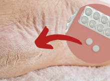 Como usar las aspirinas para eliminar hongos y pies agrietados