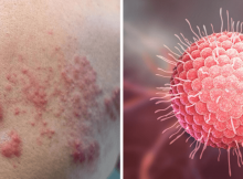 que es la culebrilla y como se contagia estres